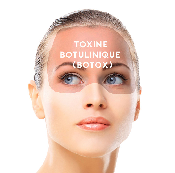 Tout savoir sur le Botox