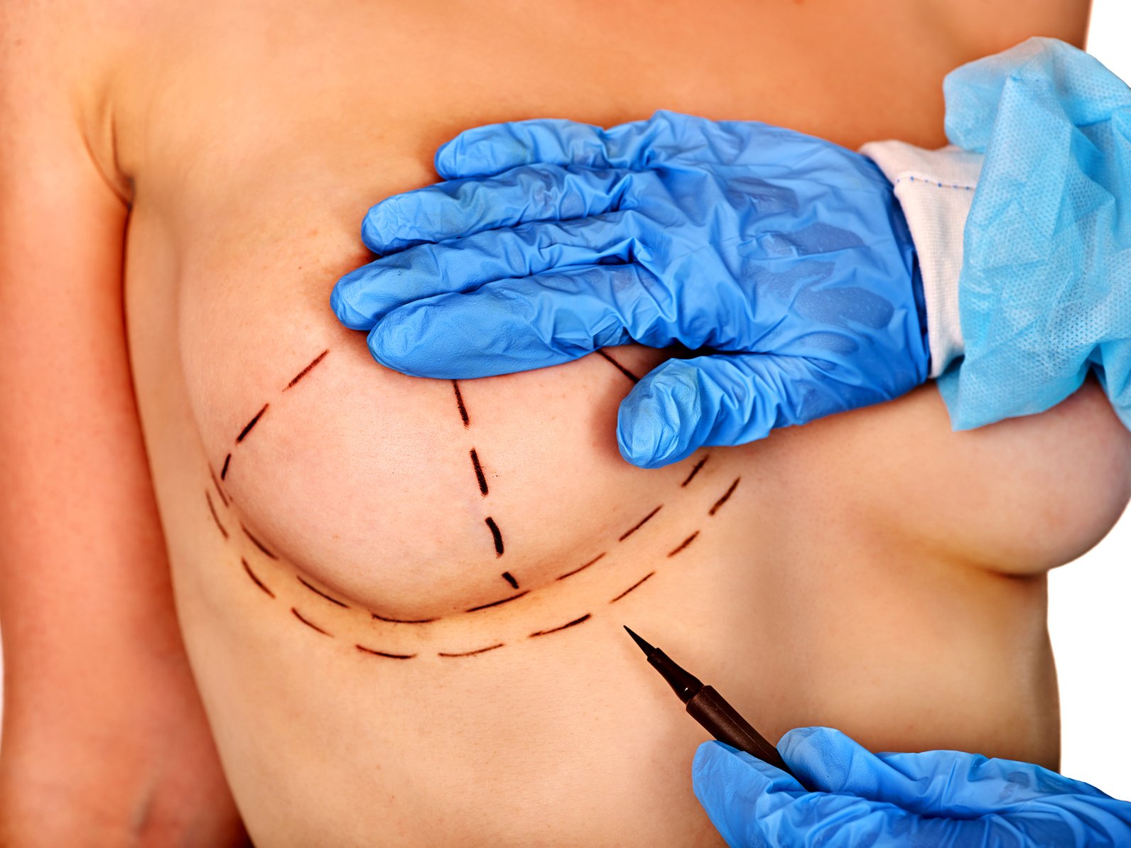 chirurgie augmentation mammaire